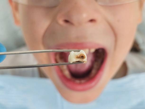 Best Emergency Treatment for Dental Infections or Abscesses in Princeton, NJ