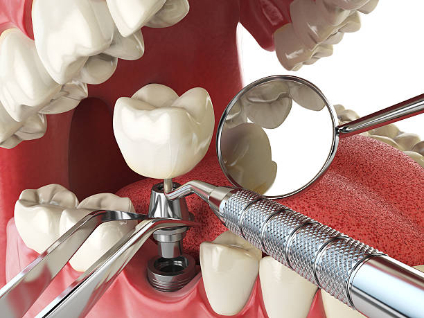 Best Emergency Root Canal Treatment in Princeton, NJ