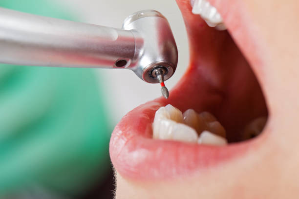 Best Emergency Dental Care for Broken or Chipped Teeth in Princeton, NJ